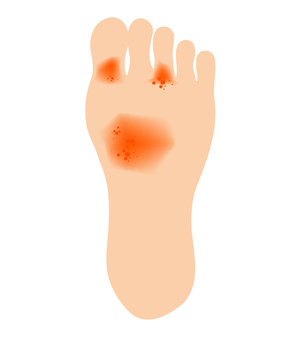 湿疹の出ている足の裏のイラスト